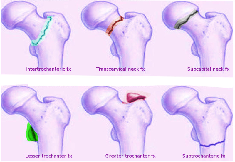 Sub Capital Femur Neck Fracture Sub Capital Femur Neck Fracture