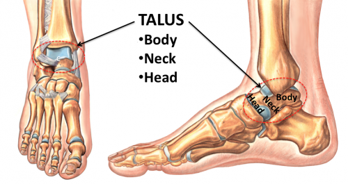 Talar Head Fractures - Causes, Symptoms, Treatment Talar Head Fractures - Causes, Symptoms, Treatment