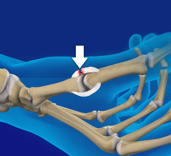 Skier’s Thumb