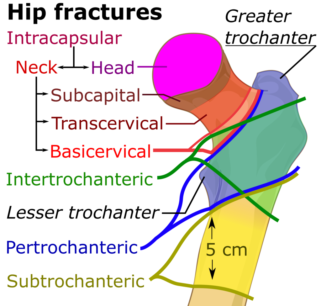 Transcervical Femoral Neck Fracture