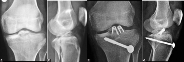 Meyers and McKeever's Classification of ACL avulsion fractures