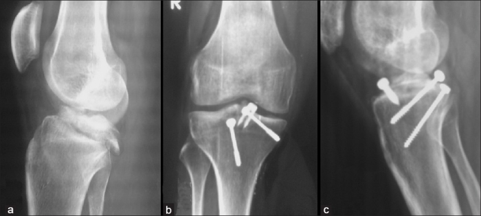 Meyers and McKeever's Classification of ACL avulsion fractures Meyers and McKeever's Classification of ACL avulsion fractures
