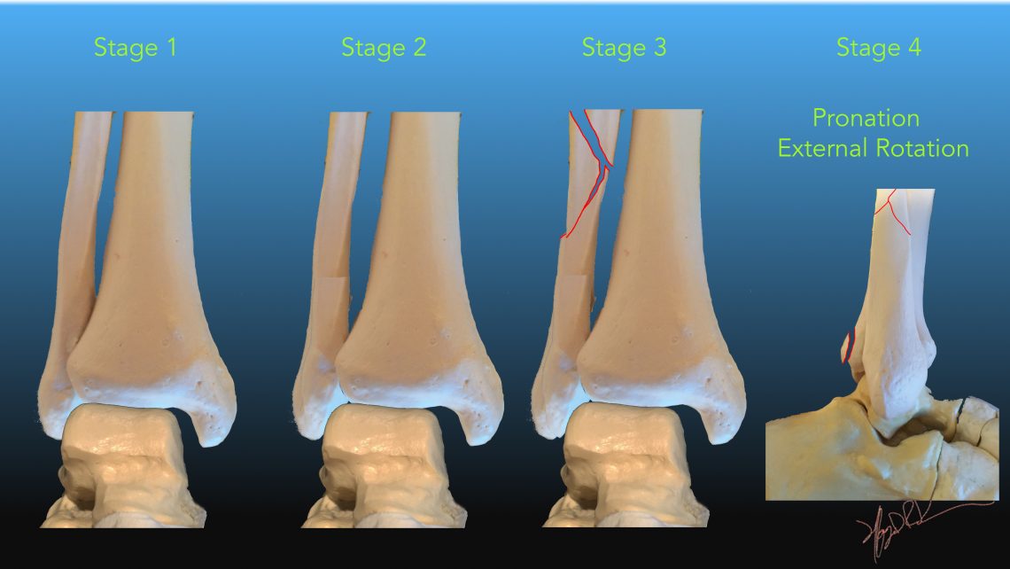 Lauge-Hansen Classification