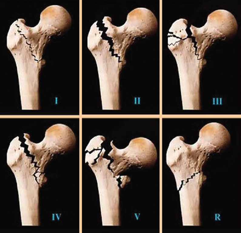 Intertrochanteric Femur Fracture