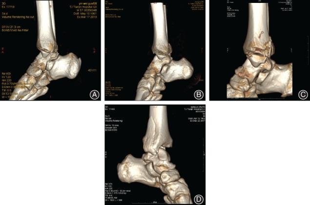 Maisonneuve Fracture Maisonneuve Fracture