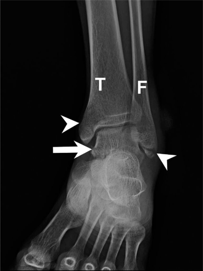 Bimalleolar Fracture Bimalleolar Fracture