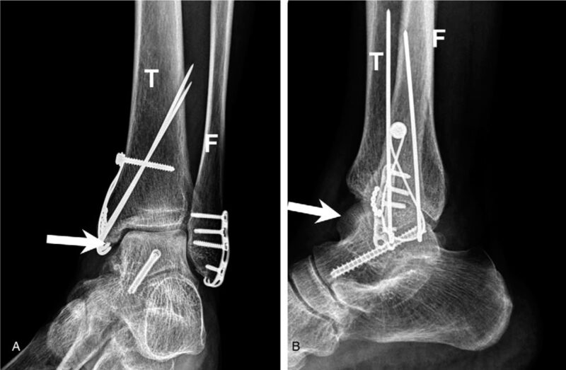 Bimalleolar Fracture Bimalleolar Fracture