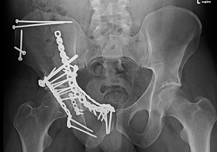 Acetabulum Fractures