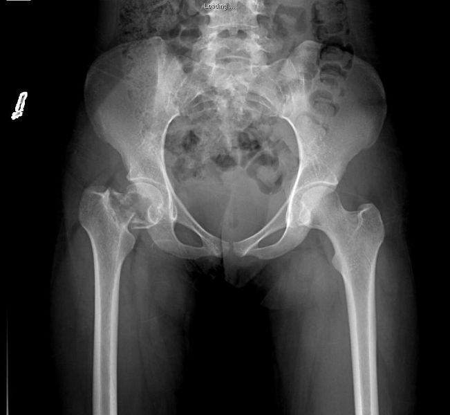 Garden Classification of Subcapital Femoral Neck Fractures Garden Classification of Subcapital Femoral Neck Fractures