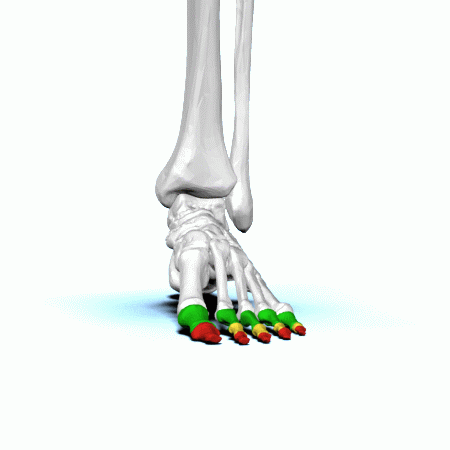 Phalangeal Neck Fractures