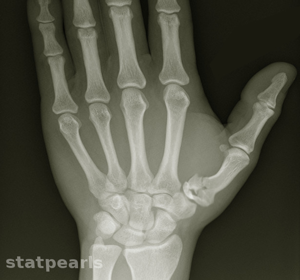 Rolando Fracture