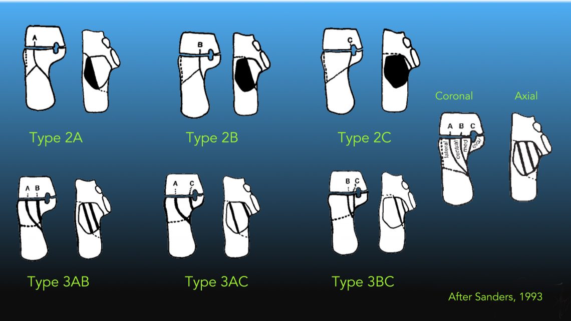 Sanders Classification of Calcaneal Fracture Sanders Classification of Calcaneal Fracture