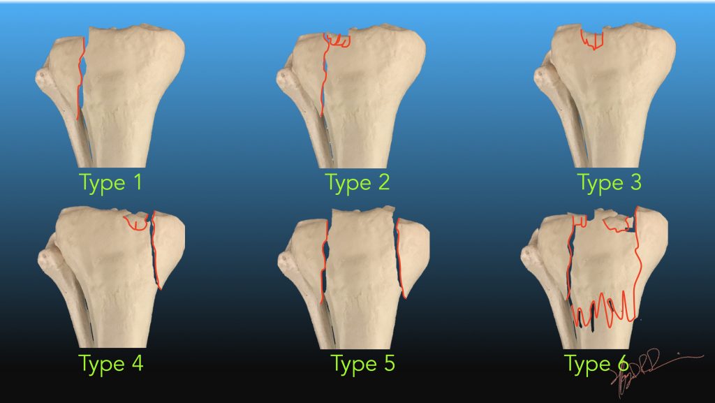 Schatzker Classification (Tibial Plateau Fracture) Schatzker Classification (Tibial Plateau Fracture)