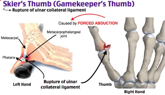 Skier’s Thumb