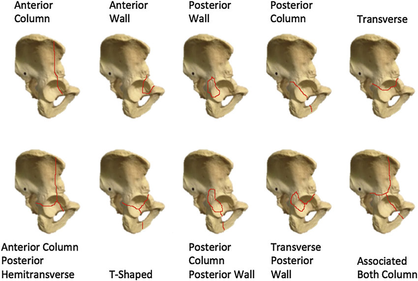 Acetabulum Fractures