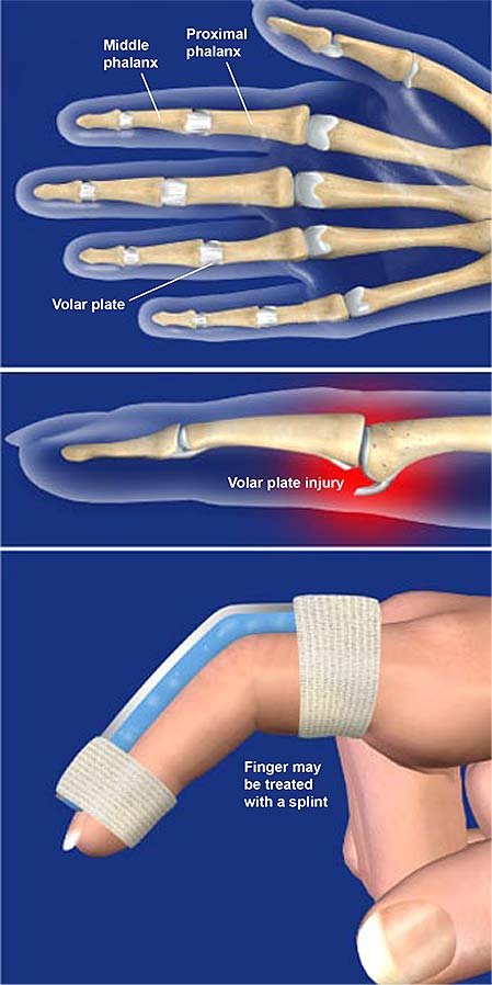 Volar Plate Fracture - Rxharun