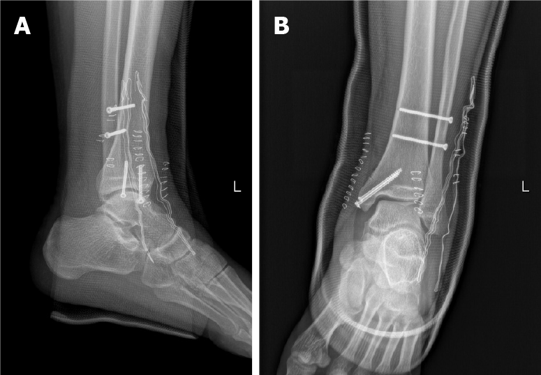 Maisonneuve Fracture Maisonneuve Fracture