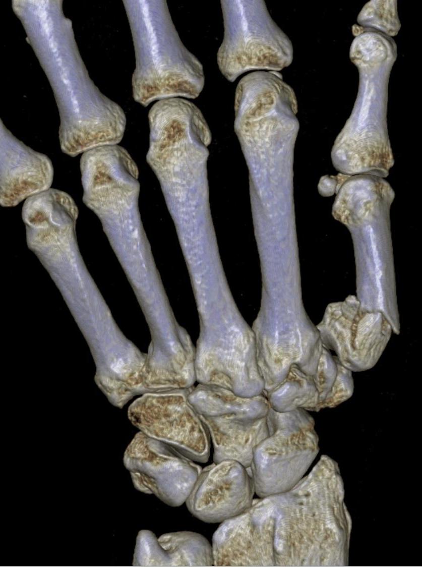 Epibasal Fractures of The Thumb