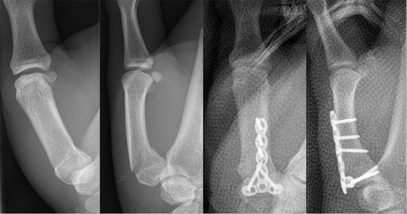 Epibasal Fractures of The Thumb