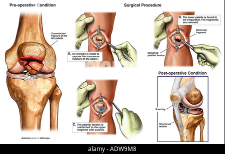 Patella Fracture - Causes, Symptoms, Diagnosis, Treatment Patella Fracture - Causes, Symptoms, Diagnosis, Treatment