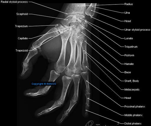 Distal Phalanx Base Fracture