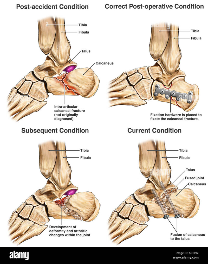 Calcaneus Fracture Calcaneus Fracture