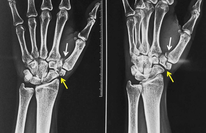 Bennett Fracture Dislocation