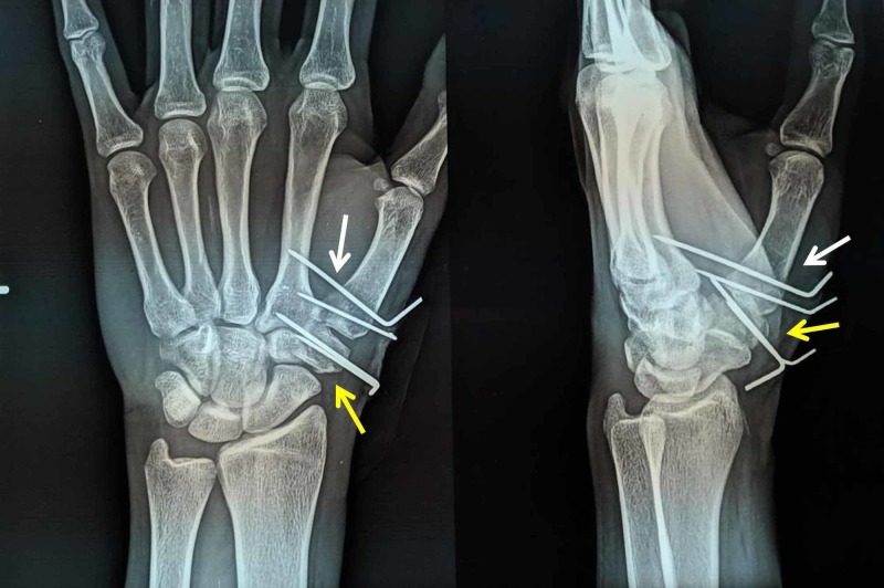 Bennett Fracture Dislocation