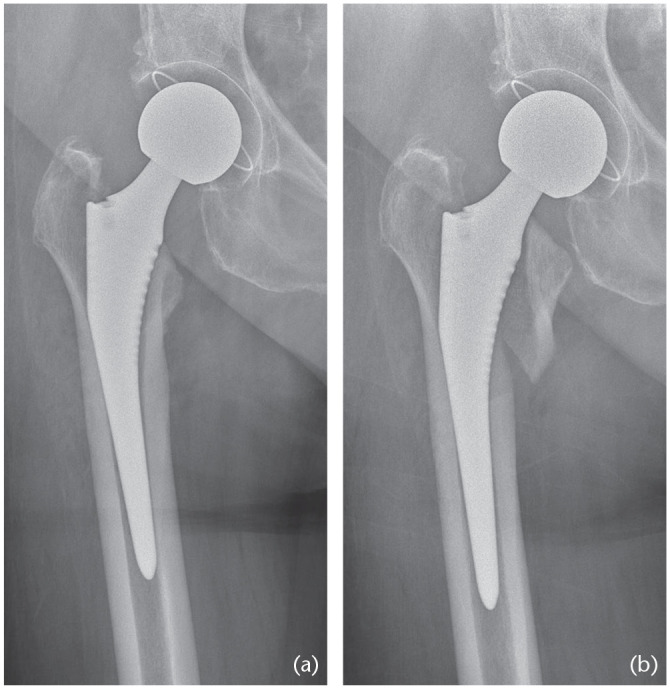 Johansson Classification of Periprosthetic Hip Fractures