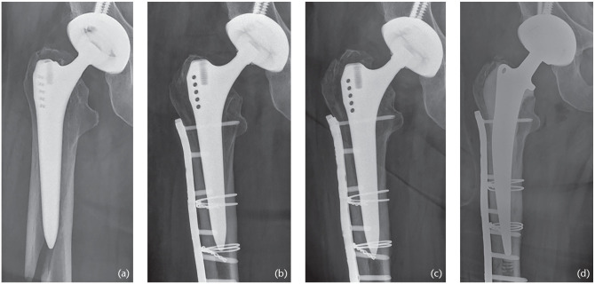 Johansson Classification of Periprosthetic Hip Fractures