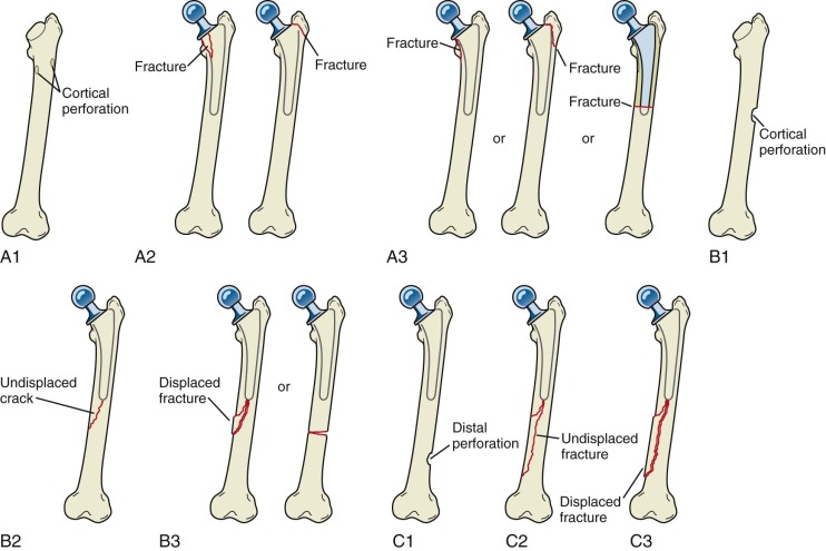 Johansson Classification of Periprosthetic Hip Fractures Johansson Classification of Periprosthetic Hip Fractures