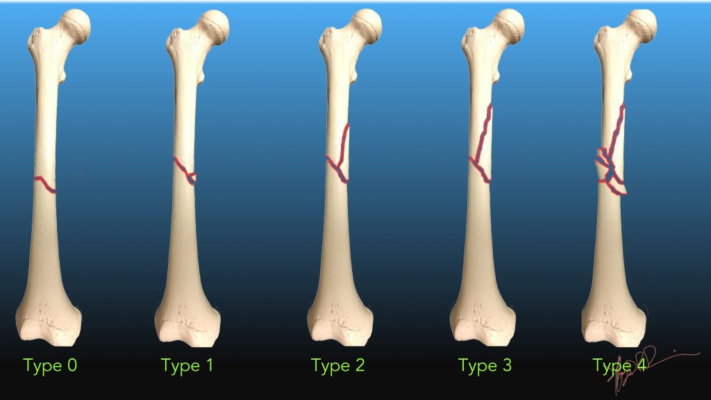 Winquist Classification and Hansen Classification Winquist Classification and Hansen Classification