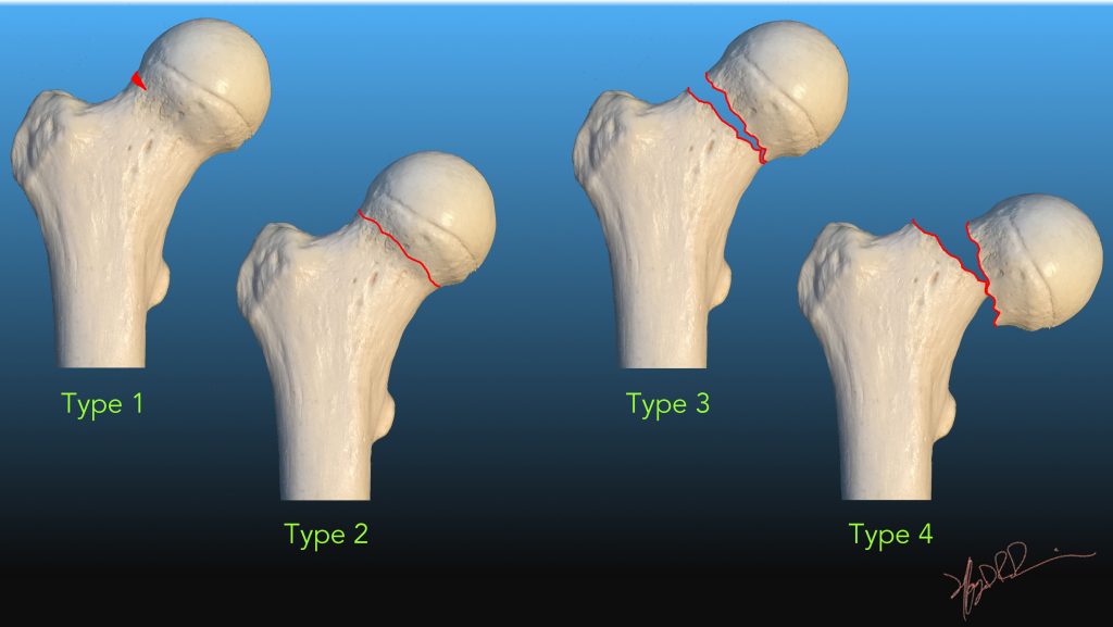 Garden Classification of Subcapital Femoral Neck Fractures Garden Classification of Subcapital Femoral Neck Fractures