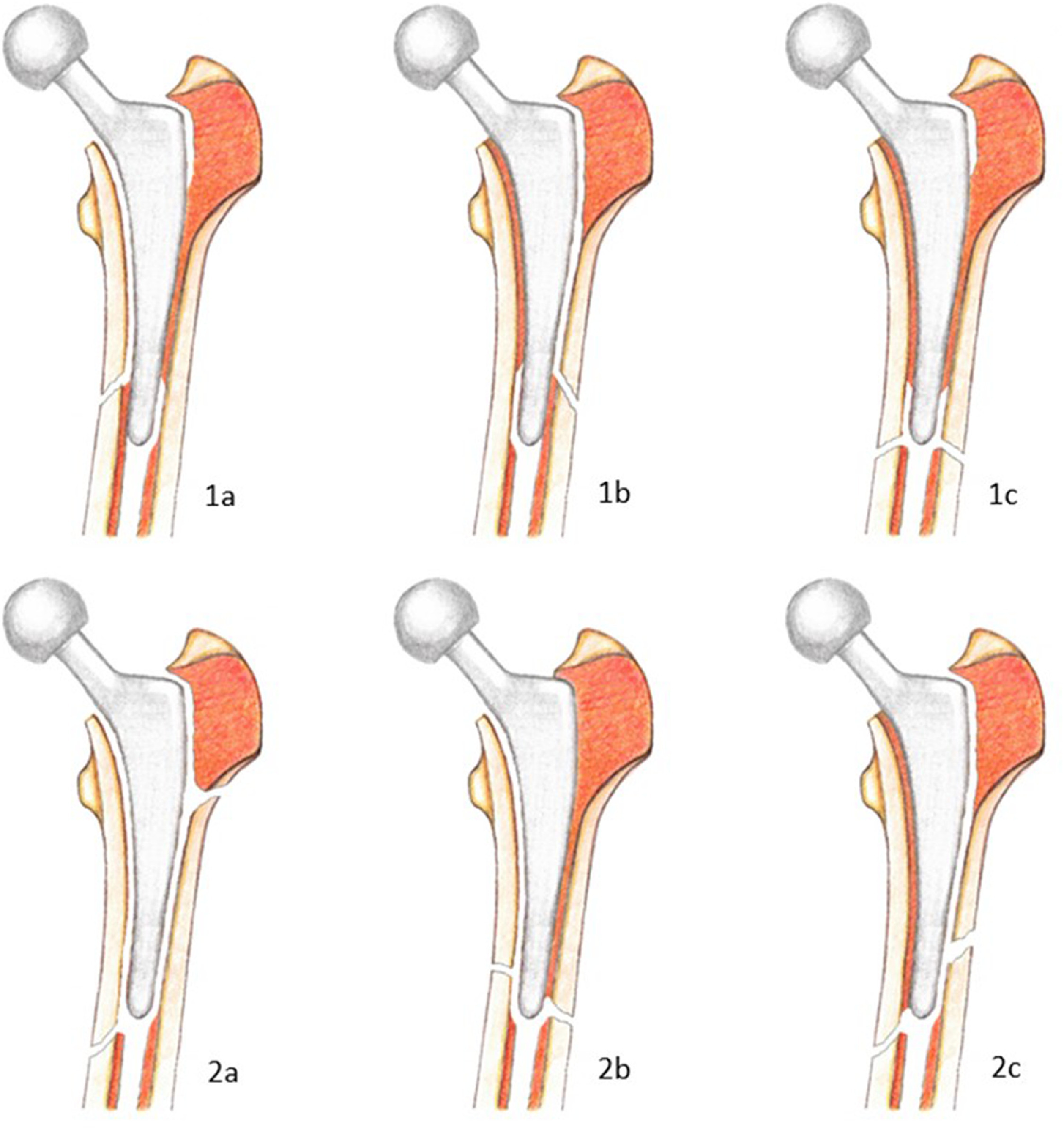 Cooke and Newman Classification of Periprosthetic Hip Fractures Cooke and Newman Classification of Periprosthetic Hip Fractures