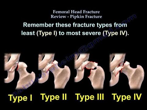 Pipkin Classification and Brumback Classifications For Femoral Head Injury Pipkin Classification and Brumback Classifications For Femoral Head Injury