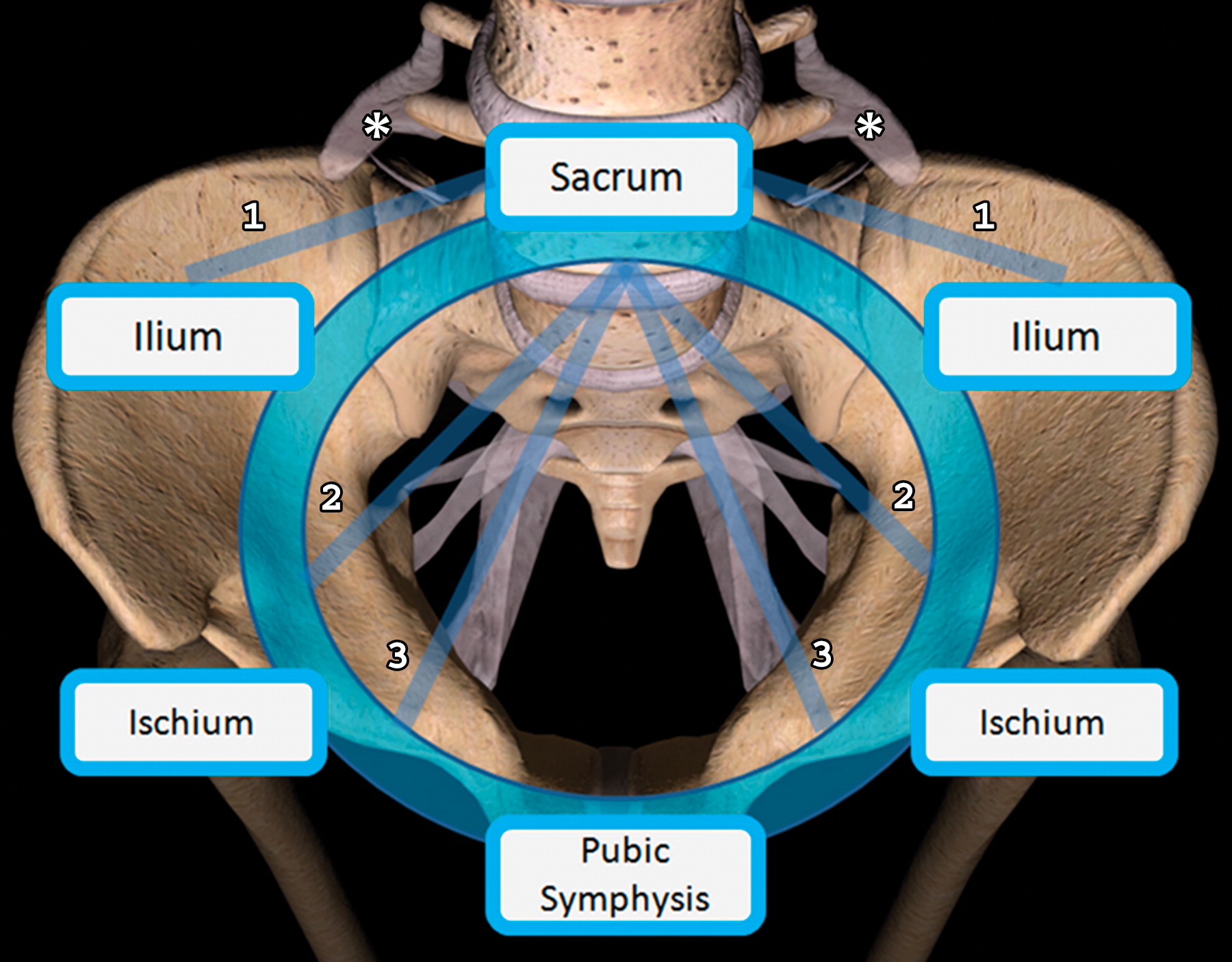 Windswept Pelvis Fracture Windswept Pelvis Fracture