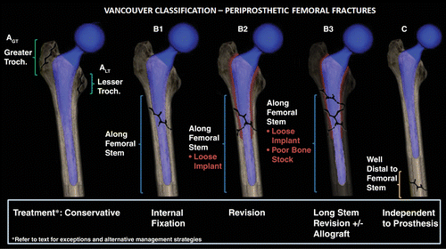 Vancouver Classification Periprosthetic Hip Fractures Vancouver Classification Periprosthetic Hip Fractures