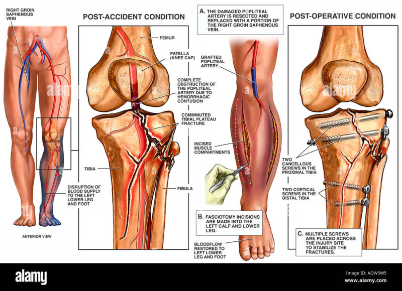 Metaphyseal-Diaphyseal Tibial Plateau Fracture Metaphyseal-Diaphyseal Tibial Plateau Fracture