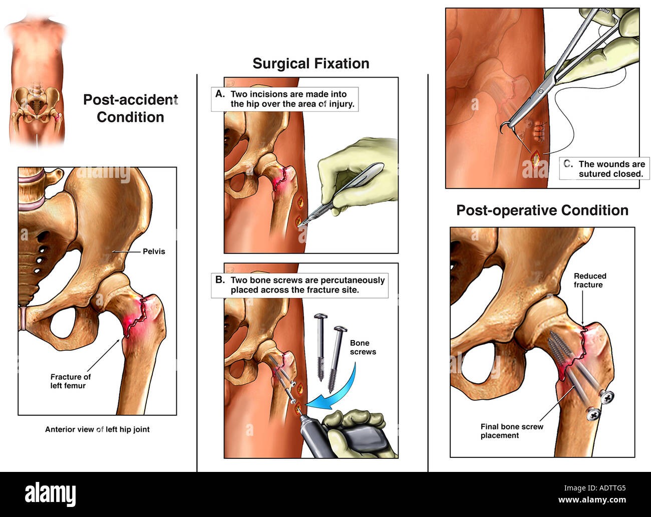 Pipkin Classification and Brumback Classifications For Femoral Head Injury Pipkin Classification and Brumback Classifications For Femoral Head Injury
