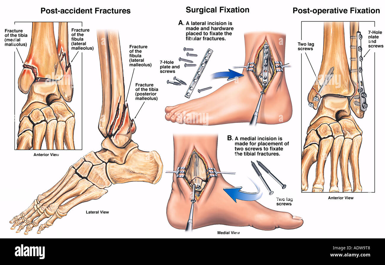 Bimalleolar Fracture Bimalleolar Fracture