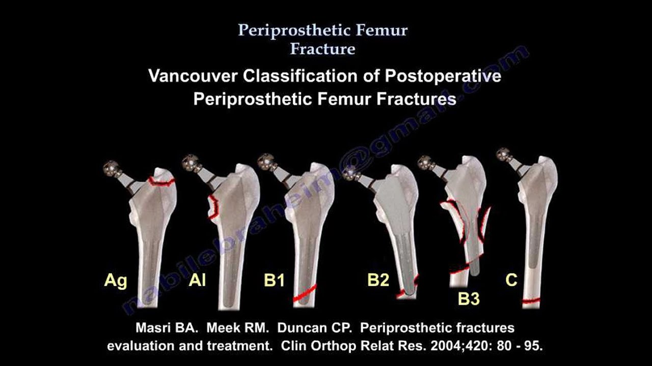Johansson Classification of Periprosthetic Hip Fractures Johansson Classification of Periprosthetic Hip Fractures