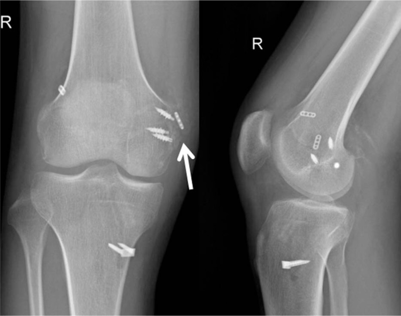 MCL Avulsion Fracture MCL Avulsion Fracture