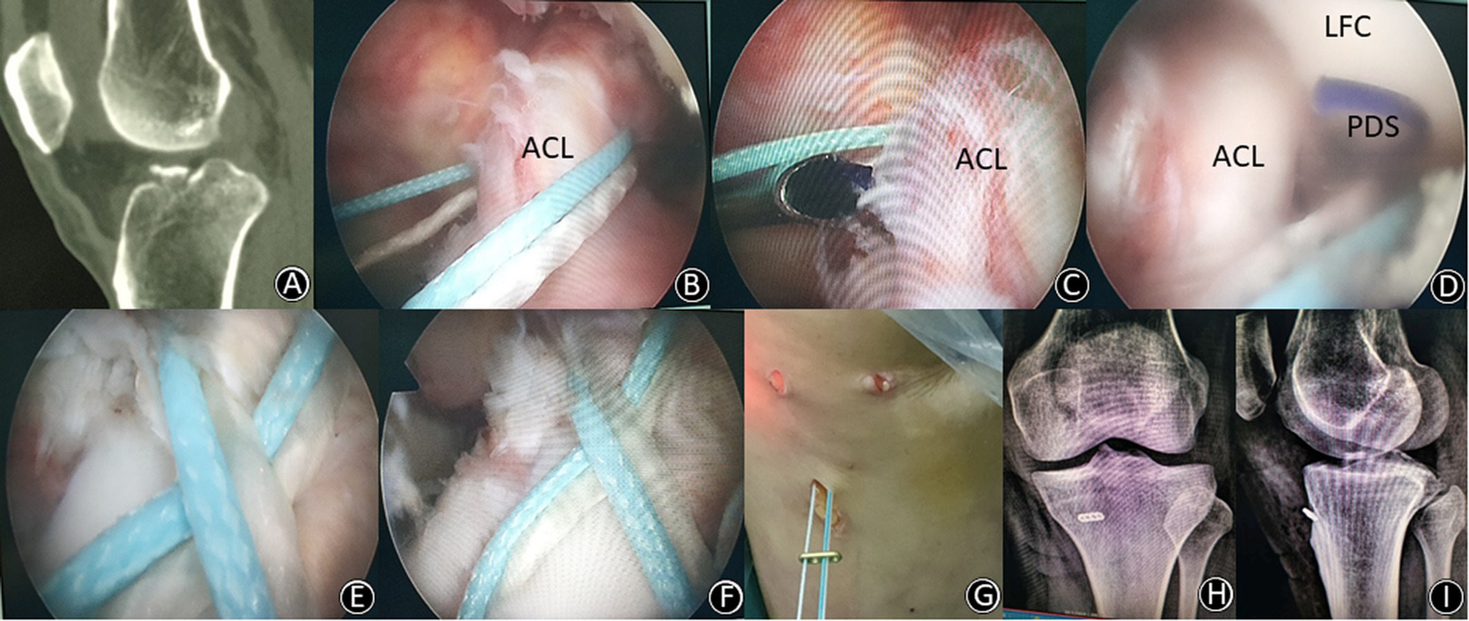 Meyers and McKeever's Classification of ACL avulsion fractures Meyers and McKeever's Classification of ACL avulsion fractures