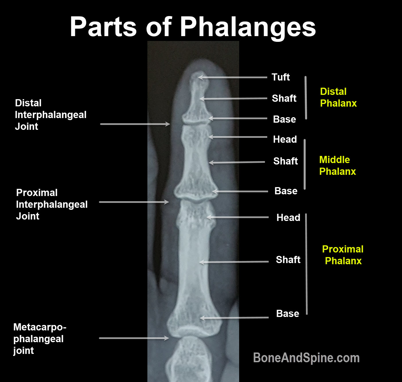 Supracondylar Fractures of The Distal Phalanx Supracondylar Fractures of The Distal Phalanx