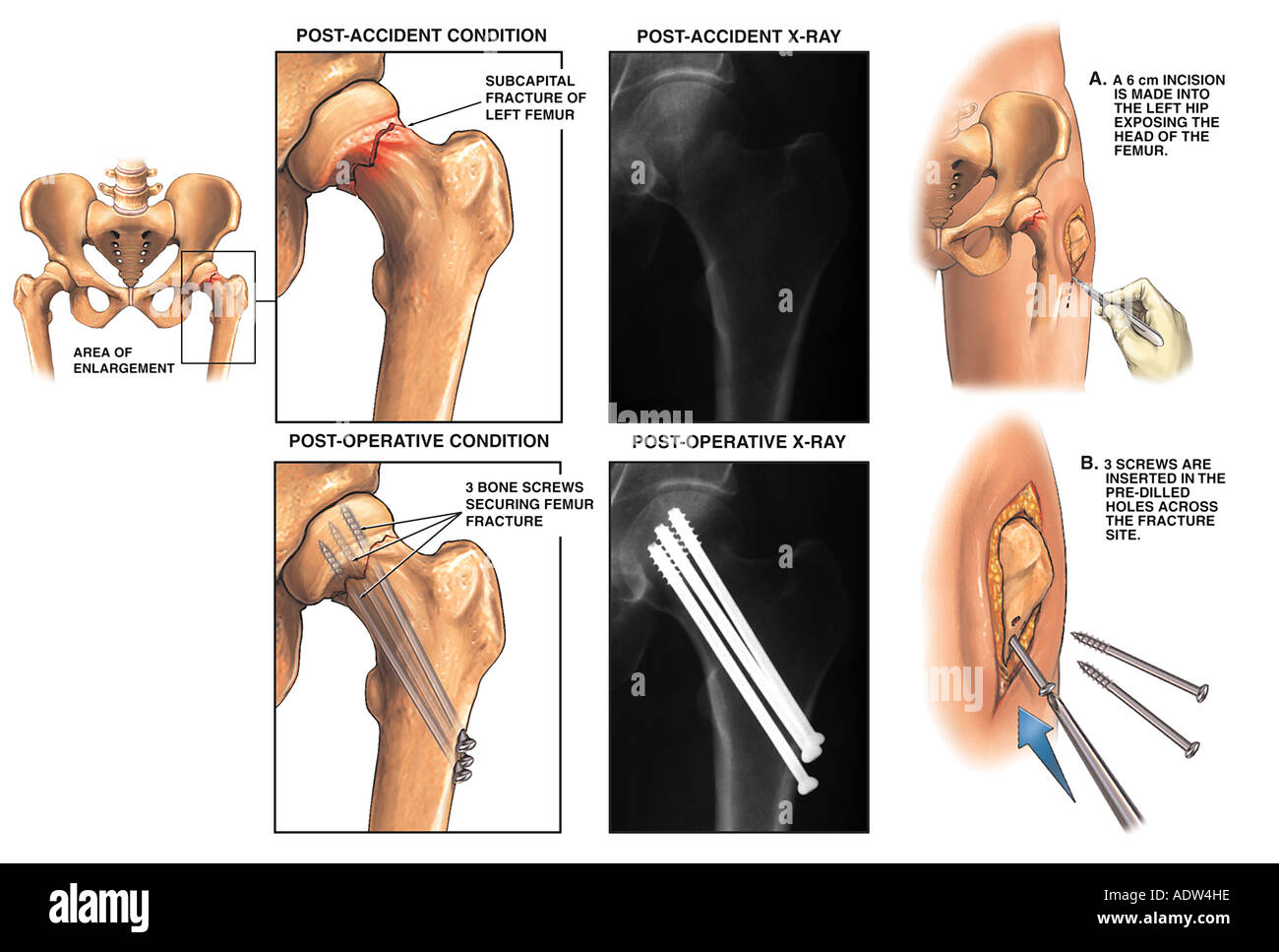 Sub Capital Femur Neck Fracture Sub Capital Femur Neck Fracture