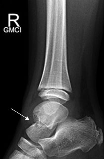 Talar Neck Fracture