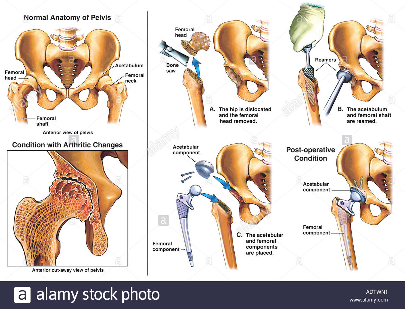Garden Classification of Subcapital Femoral Neck Fractures