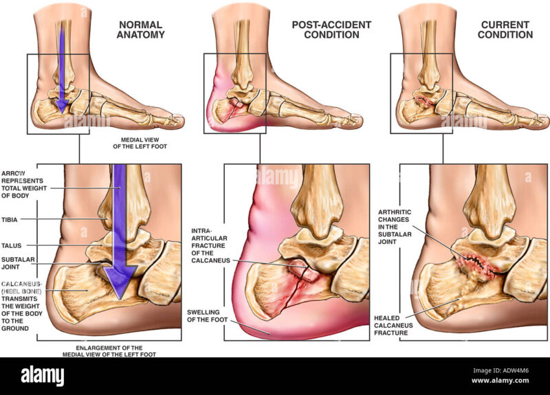 Calcaneus Fracture Calcaneus Fracture