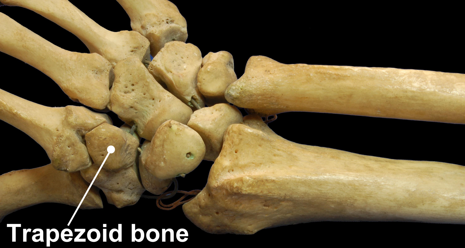 Trapezium Fracture Trapezium Fracture