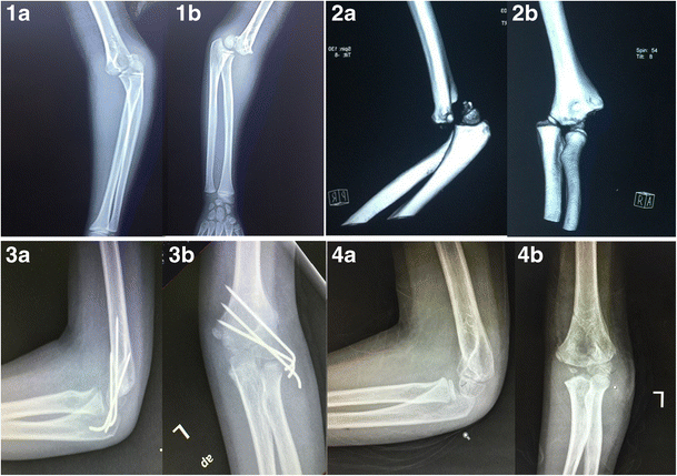 Lateral Humeral Condyle Fractures